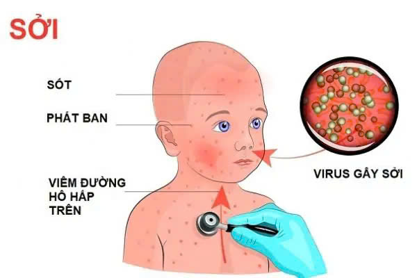 Tăng cường phòng chống dịch sởi khu vực miền Trung
